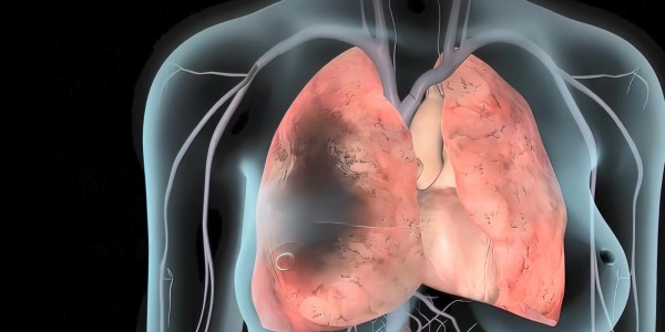   Czym jest zatorowość płucna? Przyczyny, objawy i leczenie